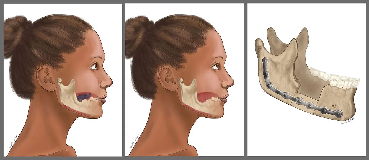 Jaw up