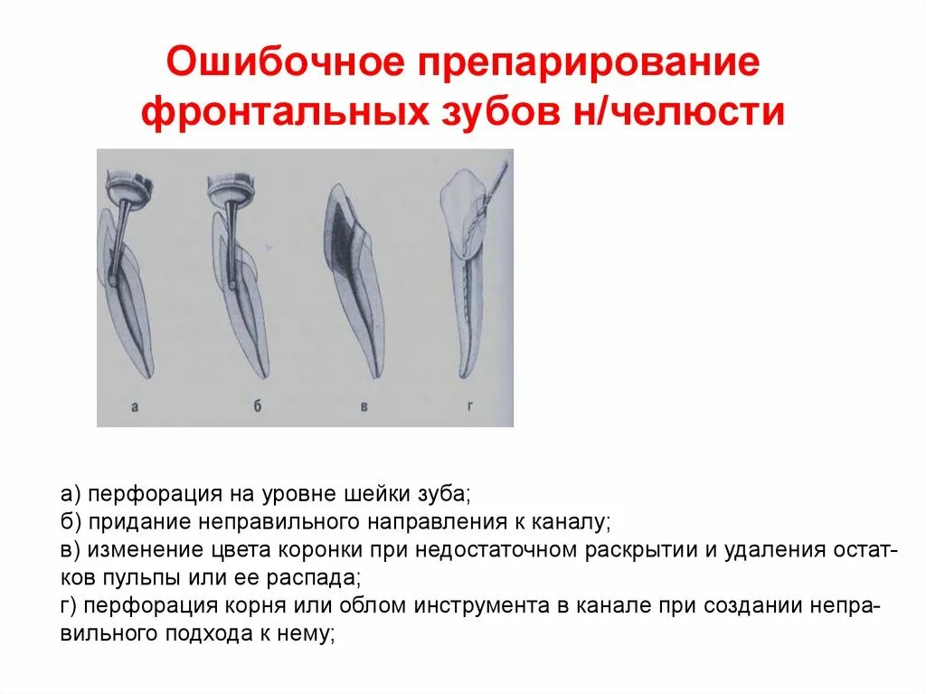 Осложнения при препарировании. Осложнения при препарировании зуба. ошибки препарирования зуба. осложнения препарирования.