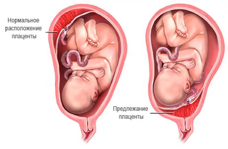 При низкой плацентации можно. Предлежание плаценты. Полное предлежание плаценты при беременности. Маргинальное предлежание плаценты. Полное предлежание плода при беременности.