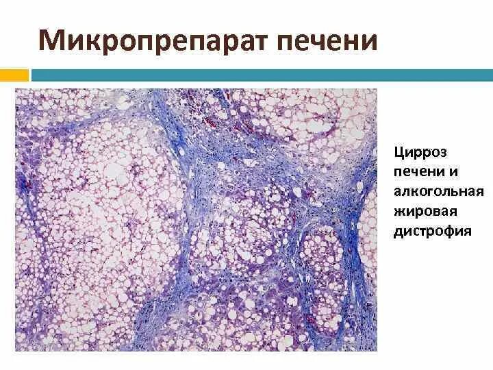 Мелкоузловой цирроз печени микропрепарат. Алкогольный цирроз печени микропрепарат. Жировая дистрофия микропрепарат. Жировая дистрофия печени микропрепарат цирроз. Алкогольная жировая болезнь