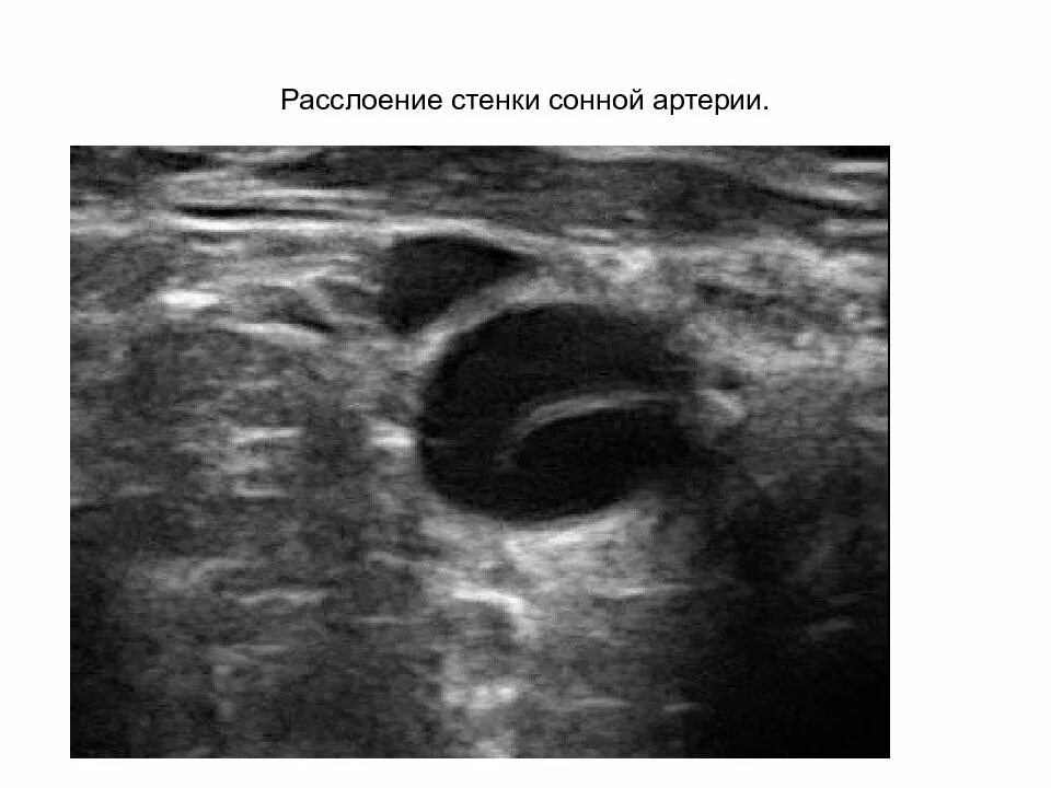 Диссекция вса. Диссекция артерии на узи. диссекция вса узи. расслоение сонной артерии на узи.