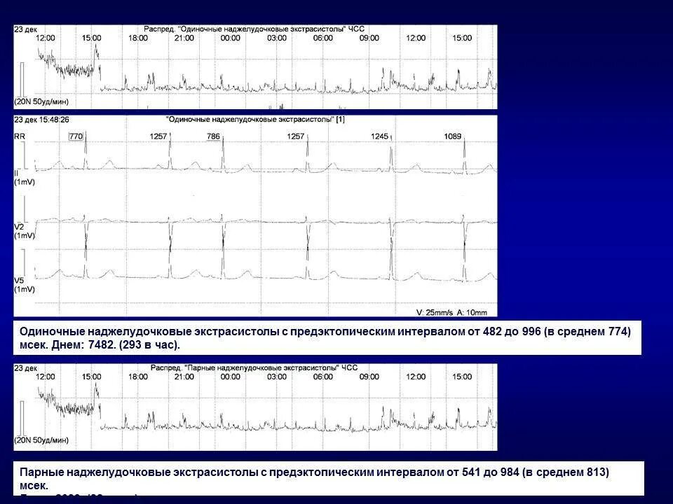 Наджелудочковая экстрасистолия Холтер. ЭКГ при наджелудочковой экстрасистолии. Парные наджелудочковые экстрасистолы. Парная наджелудочковая экстрасистолия. Норма экстрасистол в сутки по холтеру