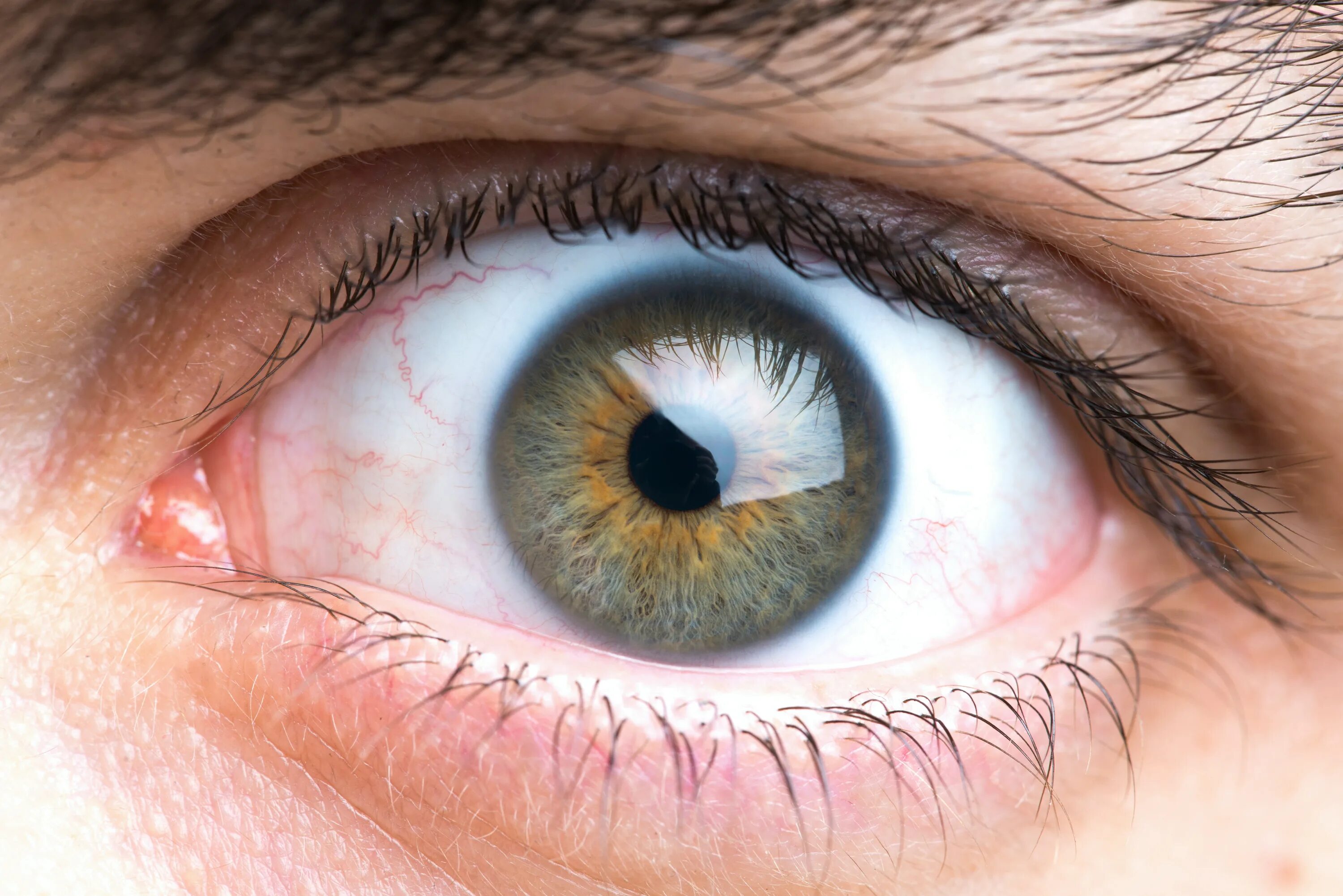 Радужка глаза строение. Прозрачный прыщик на глазном яблоке. Миоз мидриаз анизокория. Напряжение зрачка. Конъюнктивит роговицы.