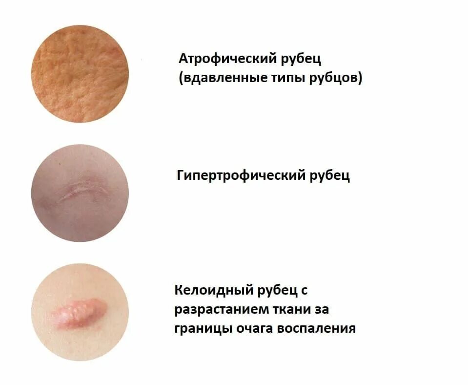 Образование шрамов