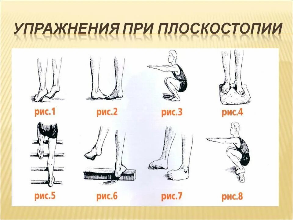 Какая нога сильнее. Плоскостопие ЛФК комплекс упражнений. ЛФК для стопы ног при плоскостопии. ЛФК при продольном плоскостопии 2 степени. Упражнения от плоскостопия 2 степени у подростков.