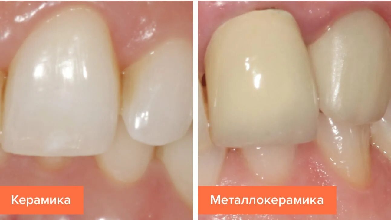 Вкладка безметалловая керамическая. Металлокерамика vs безметалловая керамика. Зубы керамика металлокерамика. Керамические коронки и металлокерамика.