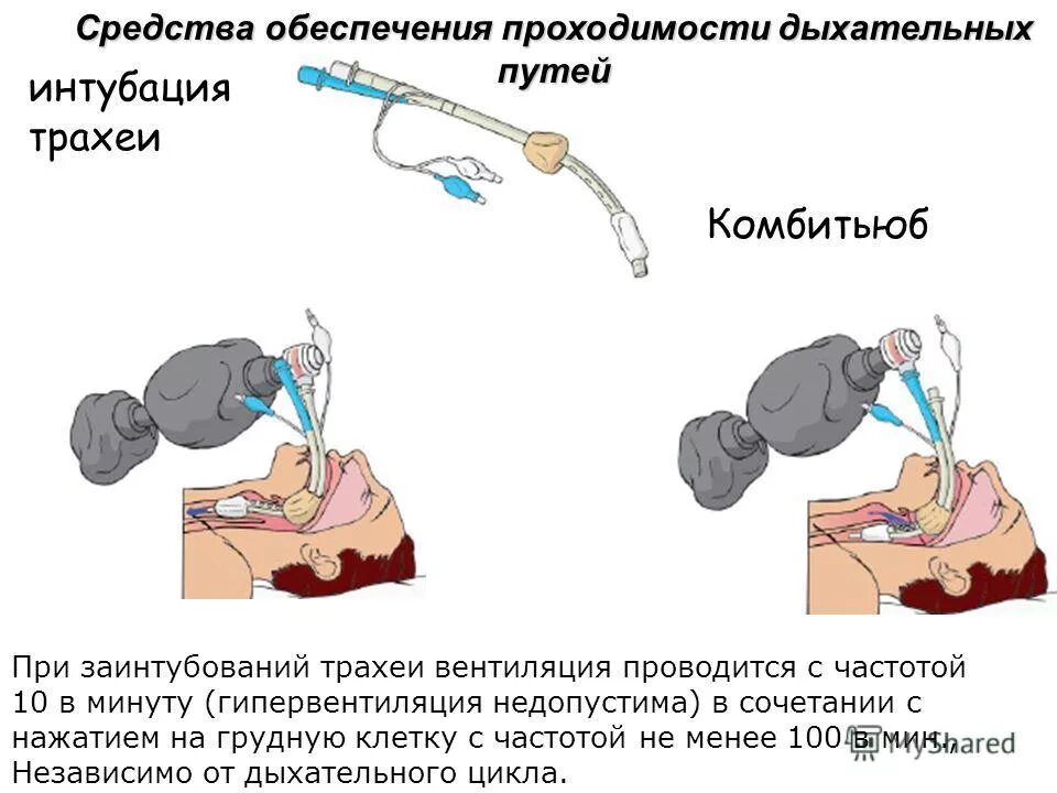 Обеспечение проходимости верхних дыхательных путей алгоритм. Методы проходимости дыхательных путей. Обеспечение проходимости дыхательных путей алгоритм. Реанимационные мероприятия начинаются с. Обеспечить проходимость дыхательных путей.