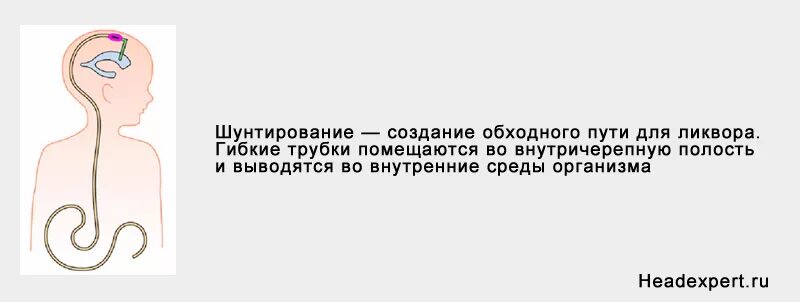 Шунты в уши ребенку. Шунтирование головы для вывода лишнего ликвора. Гидроцефалия шунтирование. Шунт для отвода ликвора.