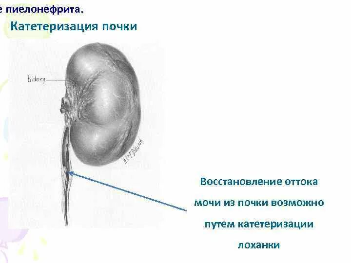 Катетеризация мочеточника. Внутренний катетер в почке. Катетеризация лоханки. Катетер постоянный для почки.