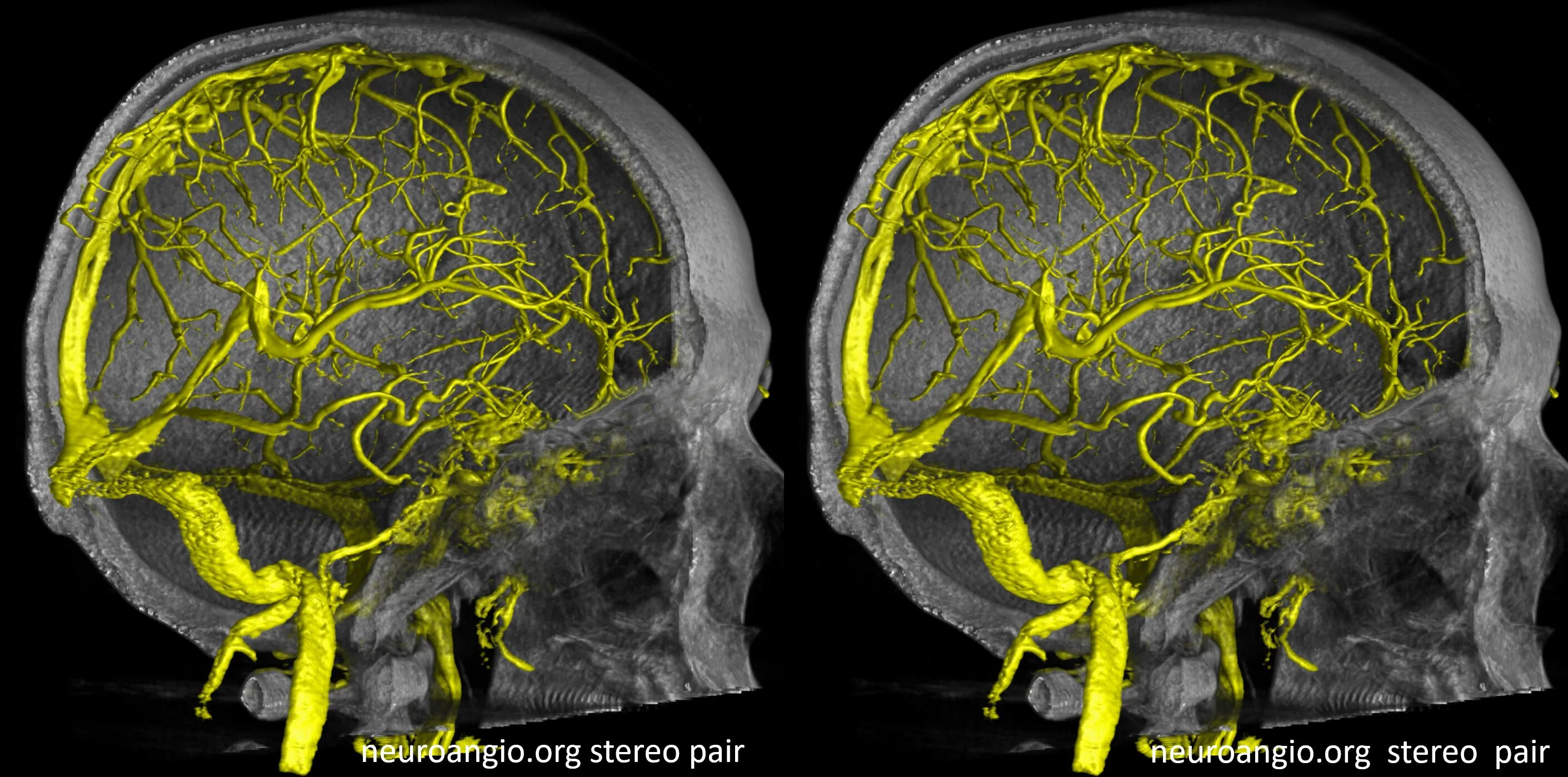 менингиома головного мозга операция отзывы