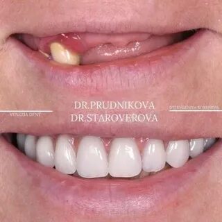 Венеция дент