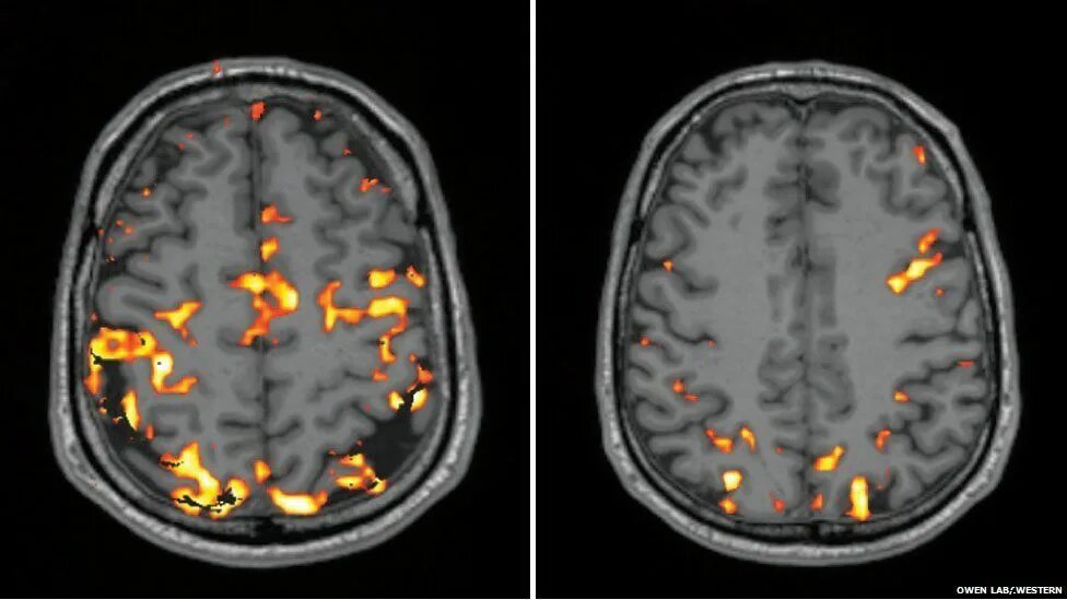 Sleeping brains. Очаги активности в мозге. Мрт снимок мозговой активности. Томограф активность мозга.