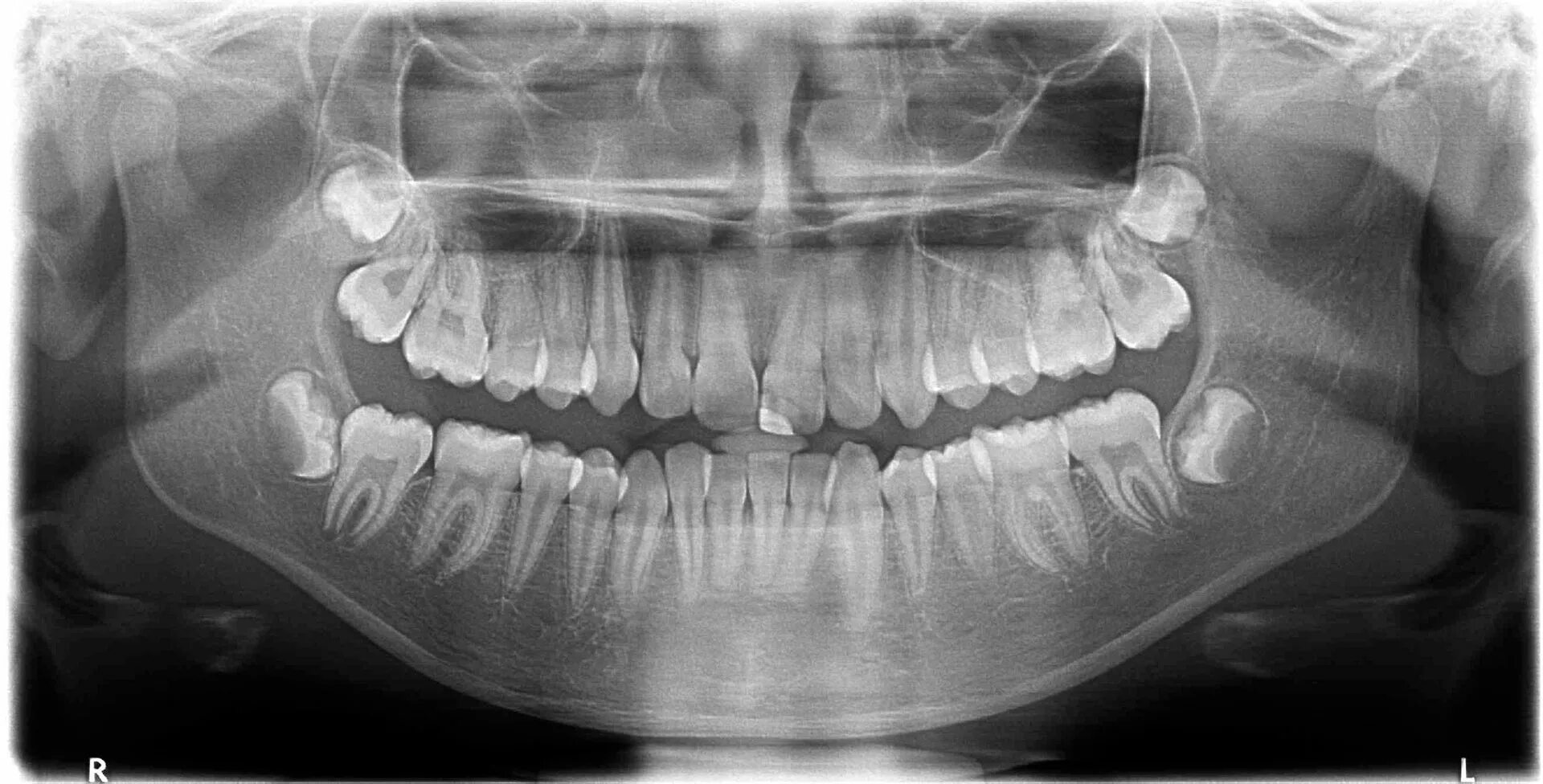 Снимок зубов видное. Ортопантомограмма челюсти. Сверхкомплектные зубы рентген. Рентген сверхкомплект зубов.