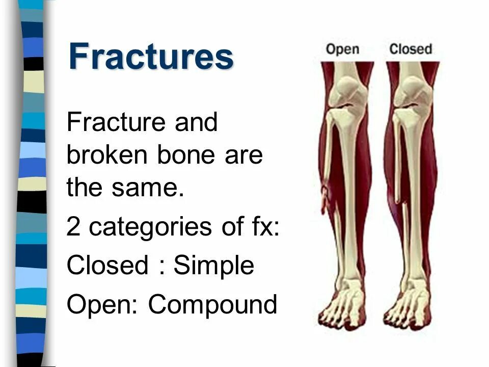 A fracture is a broken bone. A fracture is a broken bone
