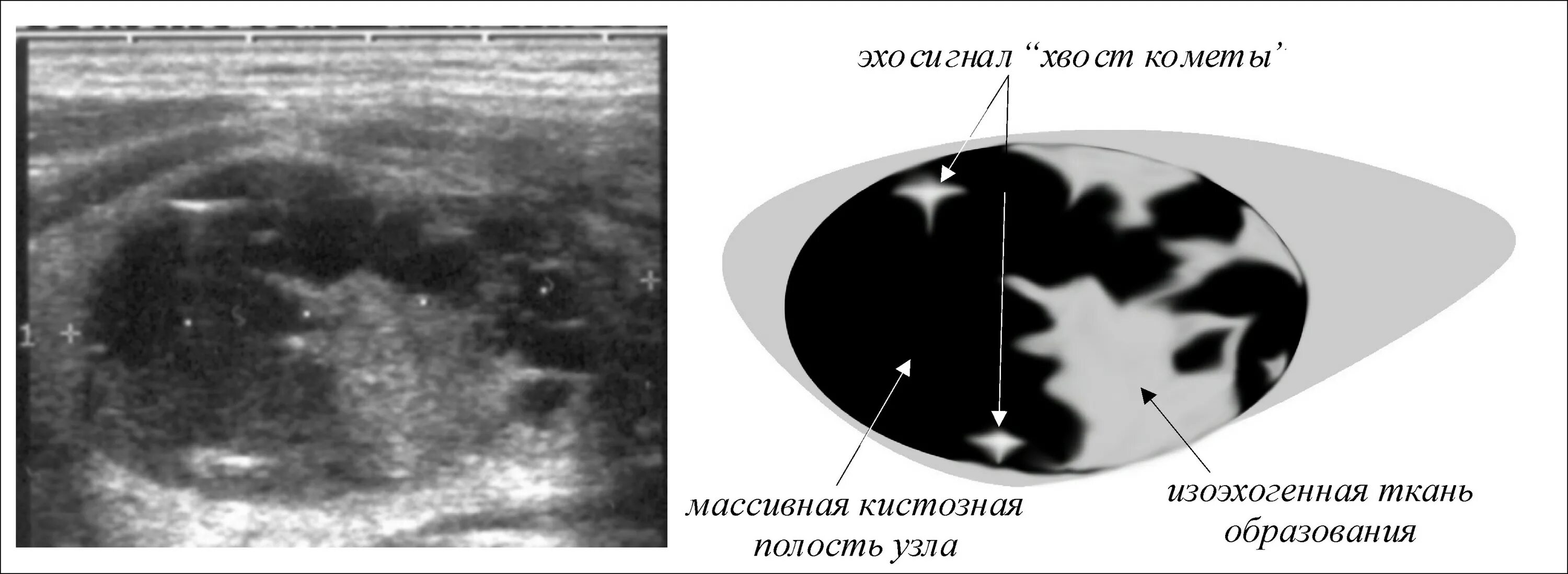 Кистозный солидный образование молочные железа. Хвост кометы на УЗИ щитовидной железы. Изоэхогенный узел щитовидной железы что это такое. Узловые образования щитовидной железы на УЗИ. Коллоидный узел УЗИ щитовидной.