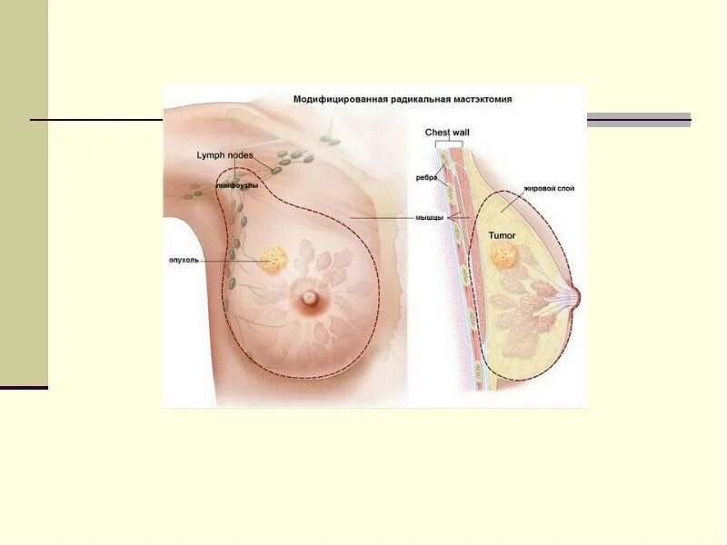 Как выглядит рак молочных желез Lobular Carcinoma. Detailed Breast Medical Anatomy Stock Vector Illustration o