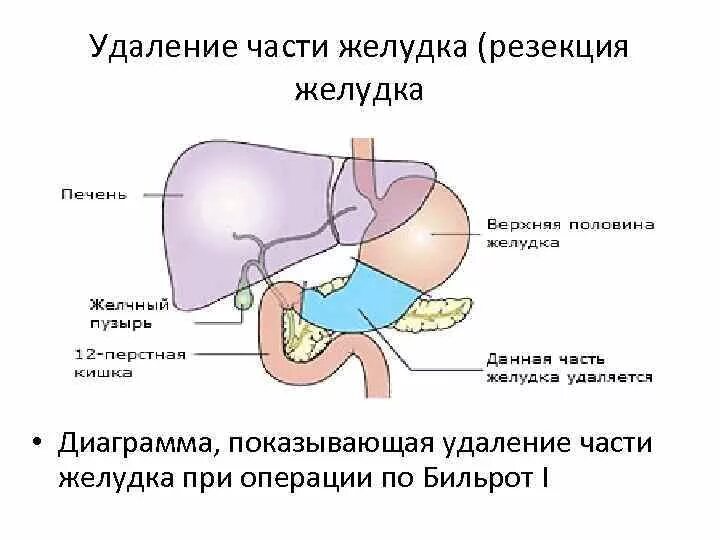 Почему после удаления желудка