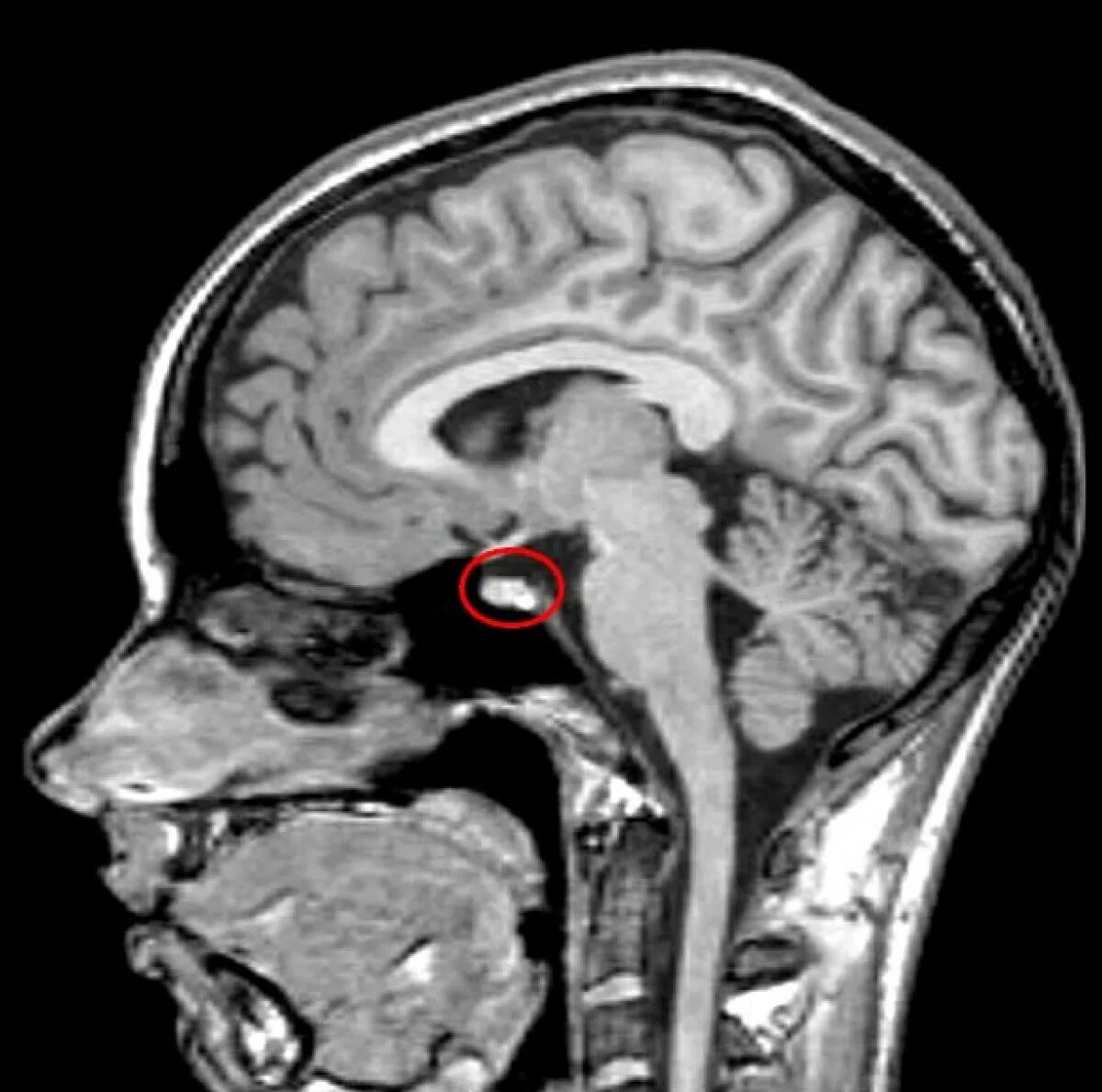 Мрт головного мозга мозжечок. Аденома гипофиза мрт. Опухоль гипофиза кт. Мрт головного мозга мозолистое тело.