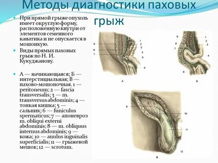 Виды паховых грыж