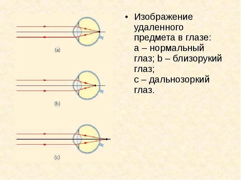 Дополните предложения изображение в близоруком