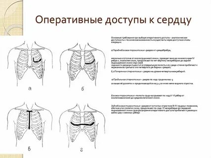 Межреберная карта вызова