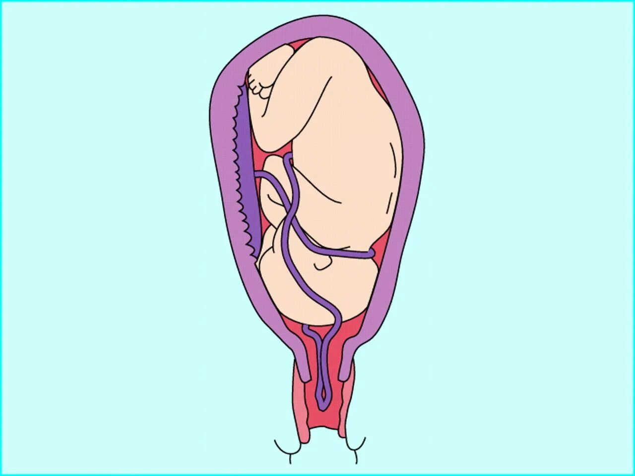 Схватки после прокола. Выпадение петель пуповины. Пролапс cervix беременные. Предлежание плаценты. Предлежание петель пуповины.