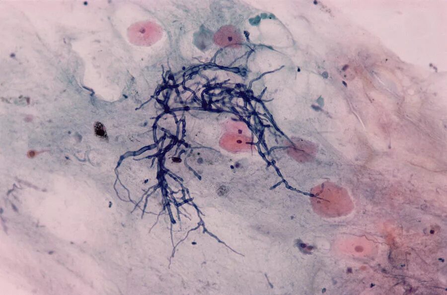 Кандидоз пищевода гистология. Молочница жкт. Кандидоз желудочно-кишечного тракта. Кандидоз кишечника схемы терапии. Диета при кандидозе желудка.