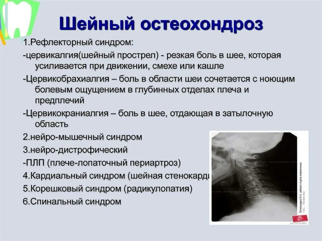 Остеохондроз локальный статус. Синдромы при шейном остеохондрозе. Синдромы остеохондроза шейного отдела. Синдромы при остеохондрозе шейного отдела. Синдром цервикалгии шейный отдел.