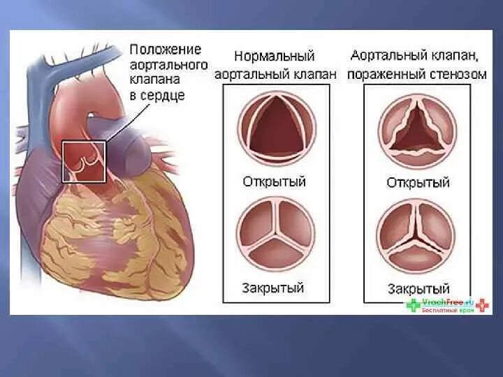 Уплотнение аортальных створок. Аортальный клапан 3 створчатый. фиброз створок аортального клапана что это такое. стеноз аортального клапана.