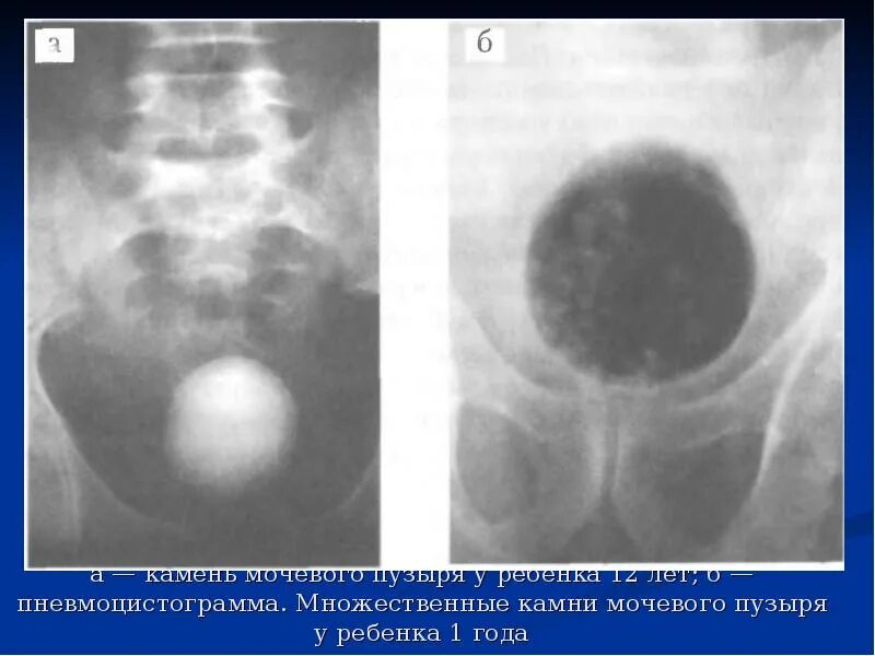 Конкременты мочевого пузыря рентген. Камни в мочевом пузыре рентген.