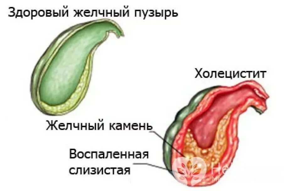 Воспалительные заболевания желчного пузыря. Холецистит желчного пузыря. Острый холецистит желчного пузыря.