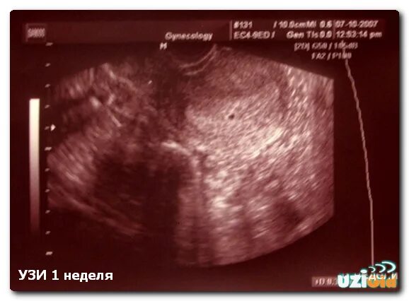 Беременность на 2-3 недели беременности на УЗИ. УЗИ 2-3 недели беременности фото. УЗИ 1 недели беременности фото.