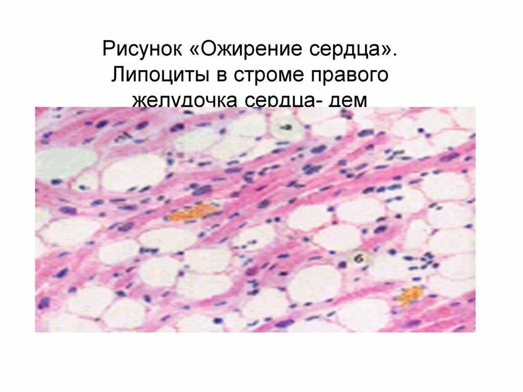 Липоциты. Липоцит гистология. Дистрофия это ожирение сердца. Ожирение сердца патологическая анатомия. Стромальные дистрофии патанатомия.