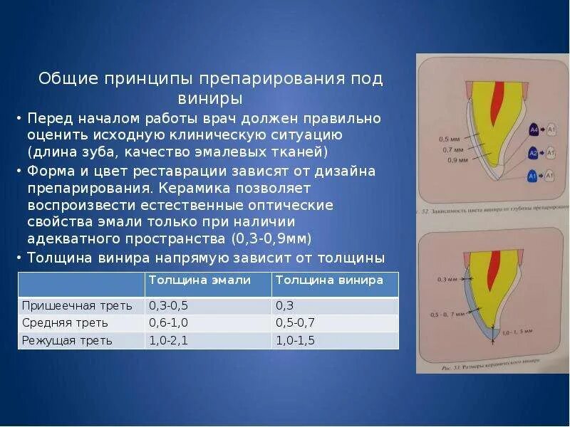 Принципы препарирования твердых тканей зуба. Принципы препарирования под виниры. принципы препарирования полостей под виниры..