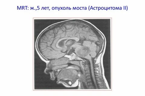 Опухоль ствола