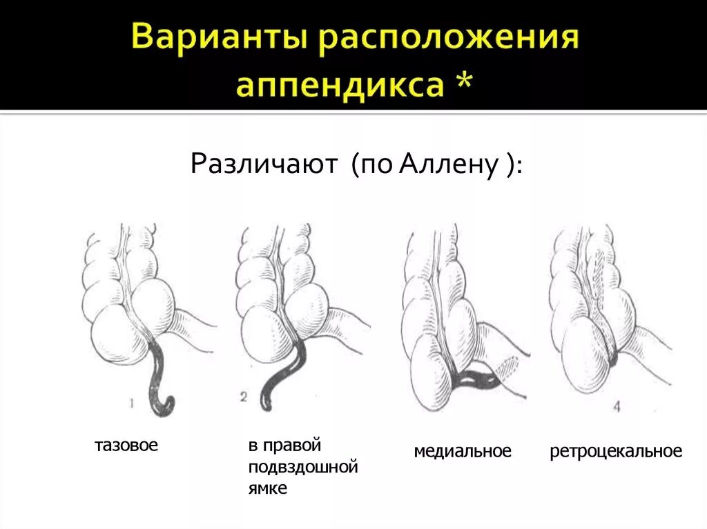 Размер аппендикса. Ретроцекальное расположение аппендицита. Расположение аппендикса у детей. Тазовое расположение червеобразного отростка. Форма аппендицита у детей.