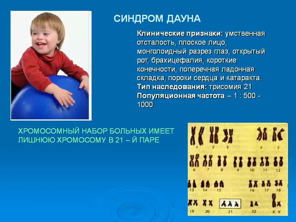 Сколько хромосом у людей с синдромом дауна. Мозаичный Тип синдрома Дауна кариотип. Болезнь Дауна трисомия. Кариотип человека с болезнью Дауна. Синдром Дауна симптомы и кариотип.