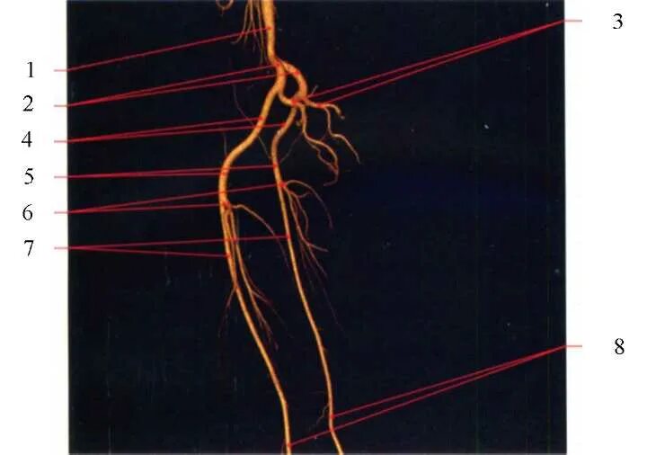 Аорты нижних конечностей. Поверхностная бедренная артерия кт. Глубокая бедренная артерия на кт. Бедренная артерия кт анатомия. Сегменты ВСА на кт анатомия.