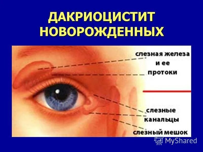 Массаж глаз слезного канала. Дакриоаденит зондирование. Конъюнктивит и дакриоцистит новорожденных. Дакриоцистит новорожденных Офтальма.