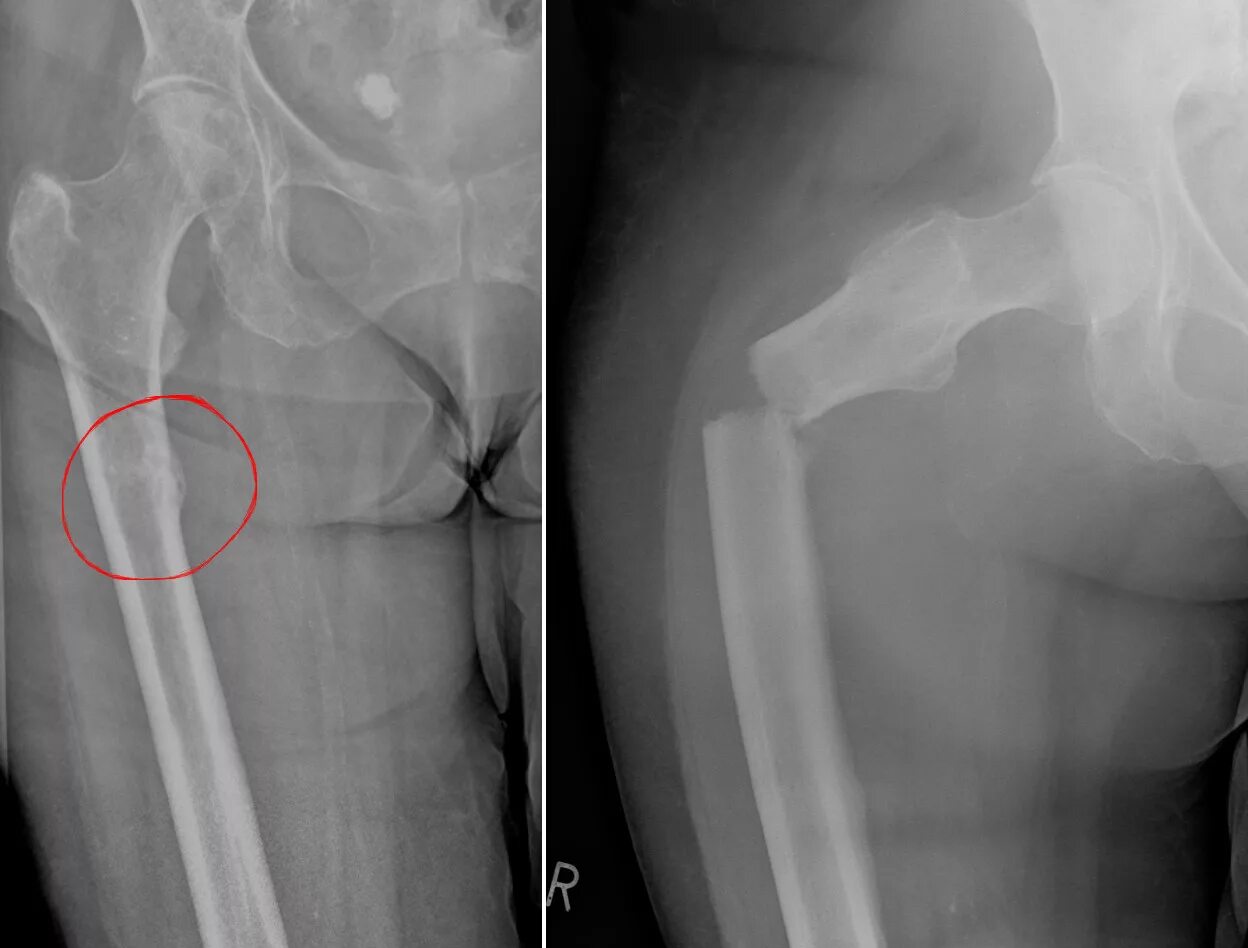 Как определить трещину в кости. Энхондрома тазобедренного сустава. Перелом бедренной кости рентген. Эностоз подвздошной кости рентген. Рентгенограмма перелом кости.