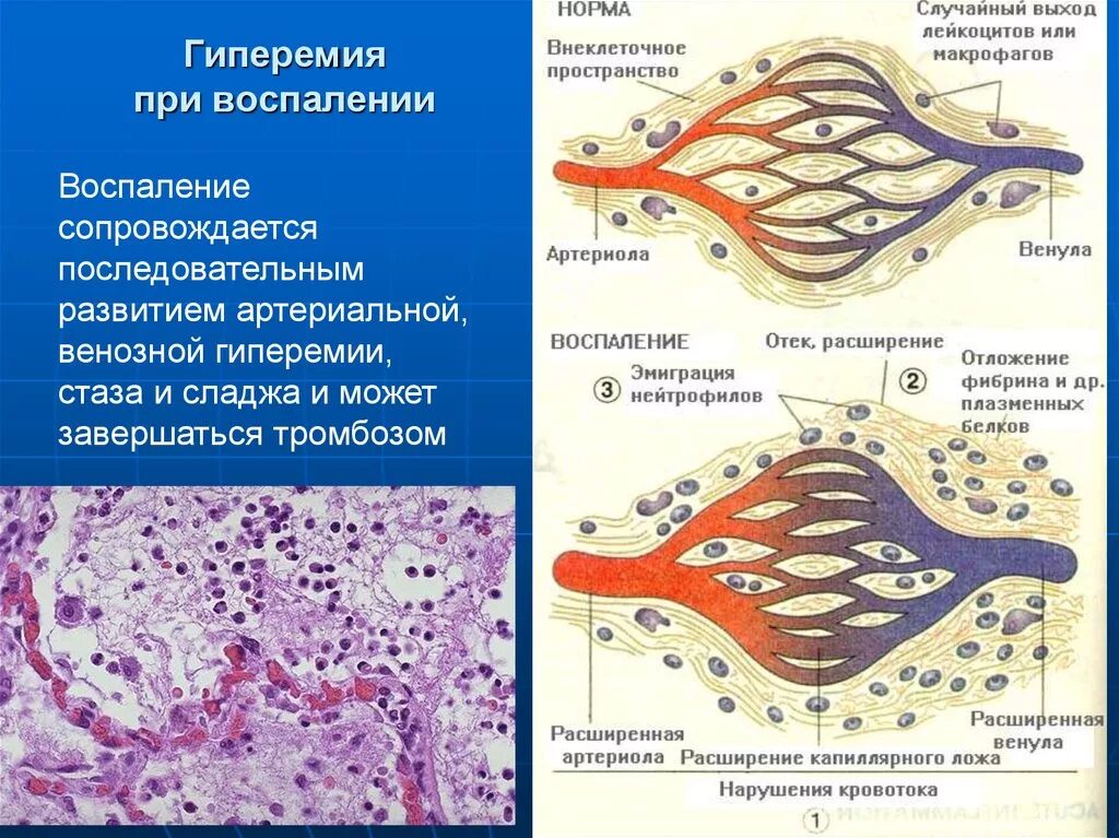 Артериальная гиперемия воспаление. Воспаление венозная гиперемия. Воспалительная артериальная гиперемия. Венозная гиперемия при воспалении. Артериальная гиперемия при воспалении.