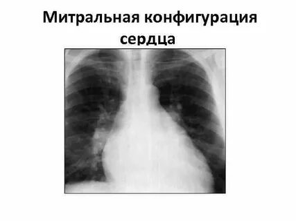 Митральное сердце