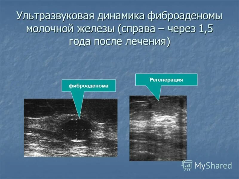 Фиброаденома молочной железы. Удаленная фиброаденома.