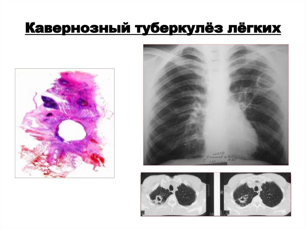 Фиброзно-кавернозный туберкулез рентген. Кавернозный туберкулез легкого рентген. Кавернозный туберкулез рентген. Фиброзно-кавернозный туберкулез легких кт.
