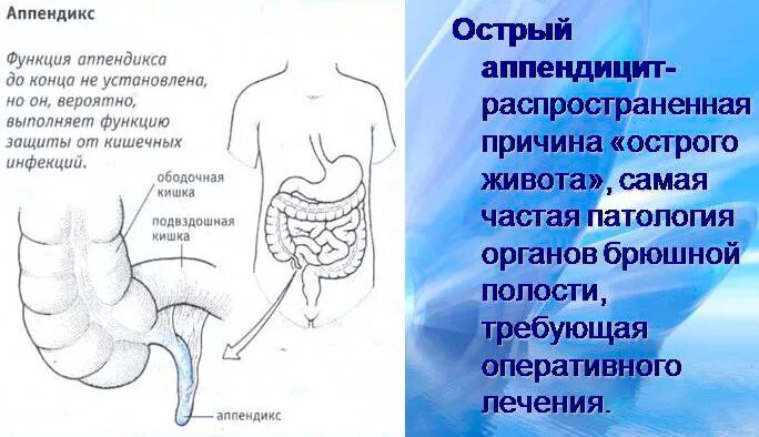 Аппендицит рекомендации. Предпосылки аппендицита.