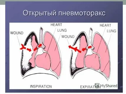 Открытый клапанный пневмоторакс