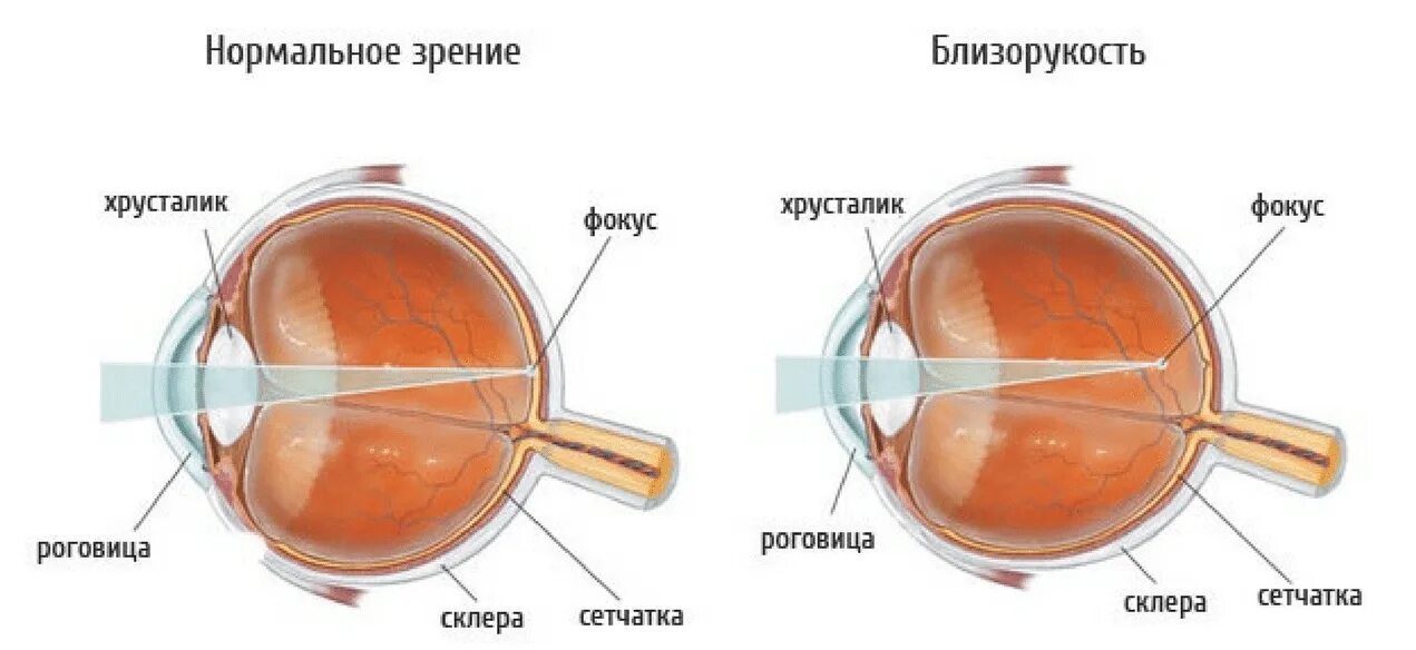 Пропадает зрение на одном глазу. Строение глаза при миопии высокой степени. Дальнозоркость и близорукость строение глаза. Анатомия глаза близорукость и дальнозоркость. Сложный гиперметропический астигматизм 1 степени.