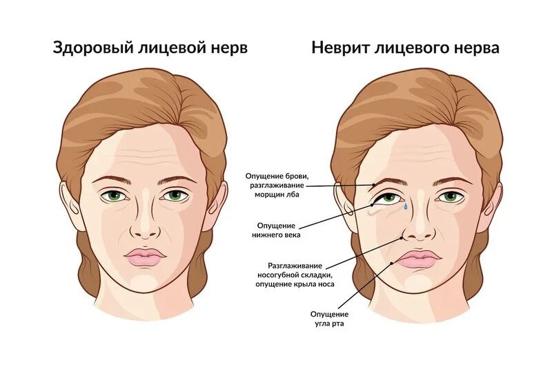 Лицевой нерв слева. Неврит лицевого нерва. Невропатия (неврит) лицевого нерва.. Неврит воспаление лицевого нерва. Неврит лицевого нерва симптомы.