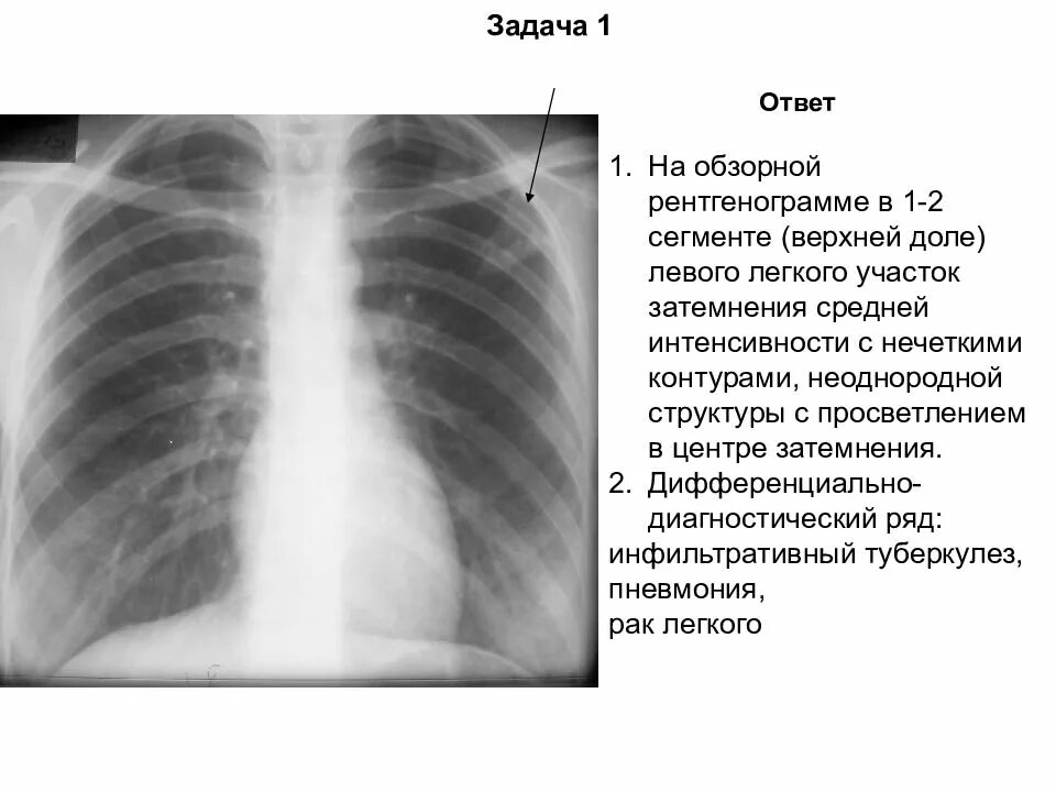 Рентген затемнение доли легкого. Рентген легких затемнение легкого. Затемнение левого легкого на рентгене. Затемнение на рентгенограмме легких. Тень в левом легком