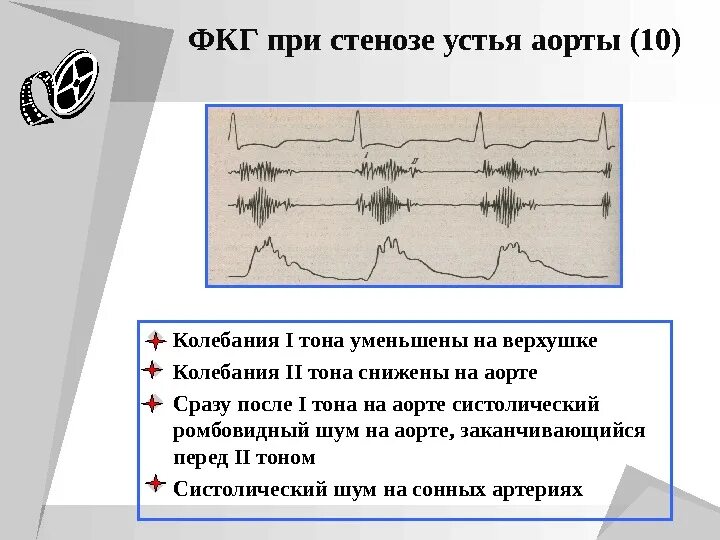 Графическое изображение фкг. Аортальный стеноз фонокардиография. фкг стеноз устья аорты. стеноз устья аорты фонокардиограмма. фкг при стенозе устья аорты.